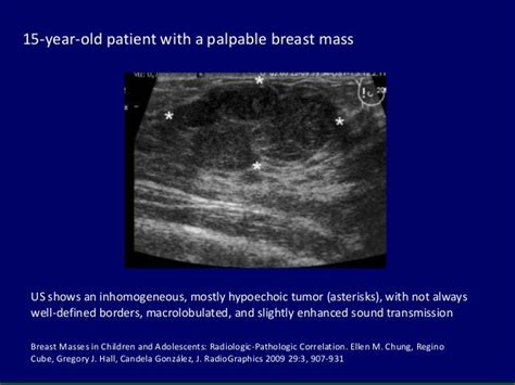 The approach to <b>breast</b> masses in children differs from that in adults in many ways, including the differential diagnostic considerations, imaging algorithm and appropriateness of biopsy as a means of further characterization. . Breast bud in 5 year old